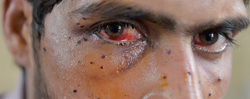 India’s Crackdown in Kashmir: Is This The World’s First Mass Blinding?