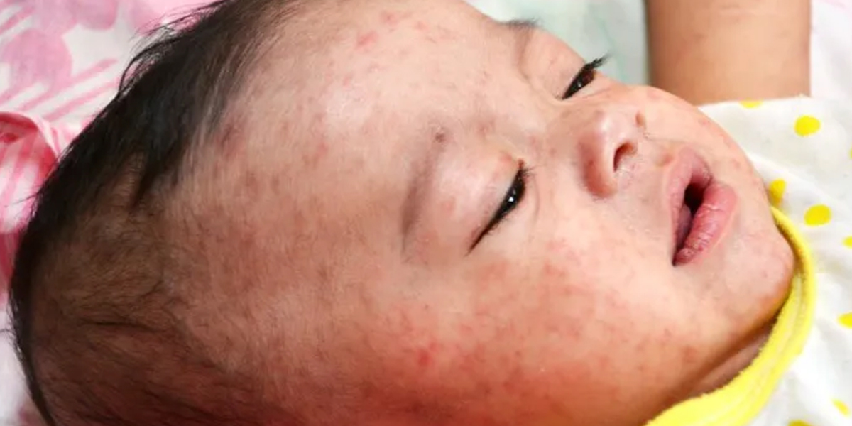 Why was Pakistan the top-ranking country with Measles (a highly contagious viral disease in children) outbreak in 2024?